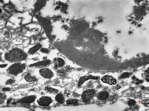 F,21y. | bone marrow - mastocytosis F,21y. | bone marrow - mastocytosis
